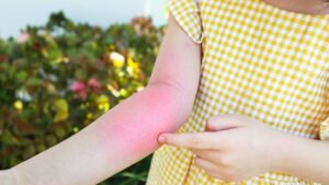 ilustrasi-alergi-atau-biduran-pada-anak_169